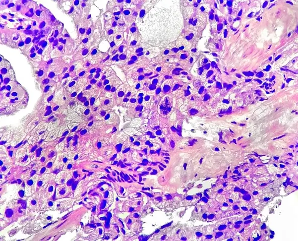 ArteraAI